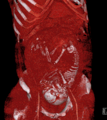 Volume rendered CT scan of a pregnancy of 37 weeks of gestational age (thumbnail).gif