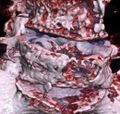 3D rendered CT of hip bone metastases (detail).jpg