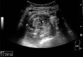 Cortical solid mass of renal cell carcinoma - local.jpg