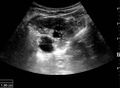 Ultrasonography of hydronephrosis with dilated anechoic pelvis and calyces, along with cortical atrophy - measurement - local.jpg