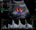 Doppler ultrasound of systolic velocity (Vs), diastolic velocity (Vd), acceleration time (AoAT), systolic acceleration (Ao Accel) and resistive index (RI) of normal kidney - local.jpg