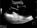 Ultrasonography of end-stage hydronephrosis with cortical thinning - local.jpg