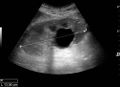 Simple cyst with posterior enhancement - local.jpg