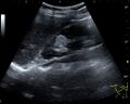 Ultrasonography of angiomyolipoma - local.jpg