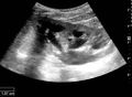 Ultrasonography of hydronephrosis with dilated anechoic pelvis and calyces, along with cortical atrophy - local.jpg
