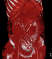 Volume rendered CT scan of a pregnancy of 37 weeks of gestational age (thumbnail).gif