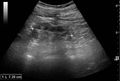 Ultrasonography of chronic pyelonephritis with reduced kidney size and focal cortical thinning - local.jpg