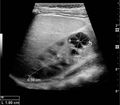 Complex cyst with thickened walls and membranes in the lower pole - local.jpg