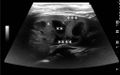 Normal pediatric kidney - local.jpg