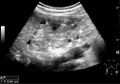 Ultrasonography of multiple angiomyolipomas in tuberous sclerosis - local.jpg
