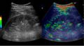 Strain elastography of a normal kidney - local.jpg