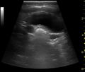 Ultrasonography of dilatation of the ureter due to vesicoureteric reflux - local.jpg