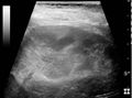 Ultrasonography of acute pyelonephritis - local.jpg