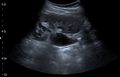 Ultrasonography of renal stone located at the pyeloureteric junction - local.jpg