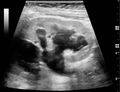 Ultrasonography of hydronephrosis due to ureteropelvic junction obstruction - local.jpg