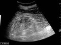 Ultrasonography of chronic renal disease caused by glomerulonephritis - local.jpg