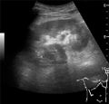 Ultrasonography of renal lymphoma - local.jpg