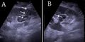Ultrasonography of percutaneous nephrostomy tube - local.jpg