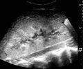 Ultrasonography of postoperative renal failure - local.jpg