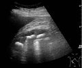 Ultrasonography of staghorn calculi filling the entire collecting system - local.jpg