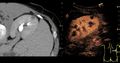 Contrast-enhanced ultrasonography of benign lesion - local.jpg