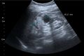 Renal cell carcinoma with both cystic and solid components - local.jpg
