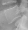 Spondylolisthesis - crop X-ray.jpg