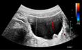 Ultrasonography of left hydroureter with ureteric jet - local.jpg