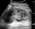 Ultrasonography of renal trauma with laceration - local.jpg