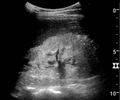 Ultrasonography of kidney with nephrotic syndrome - local.jpg