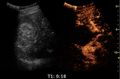 Contrast-enhanced ultrasonography of renal cell carcinoma successfully treated with thermal ablation - local.jpg